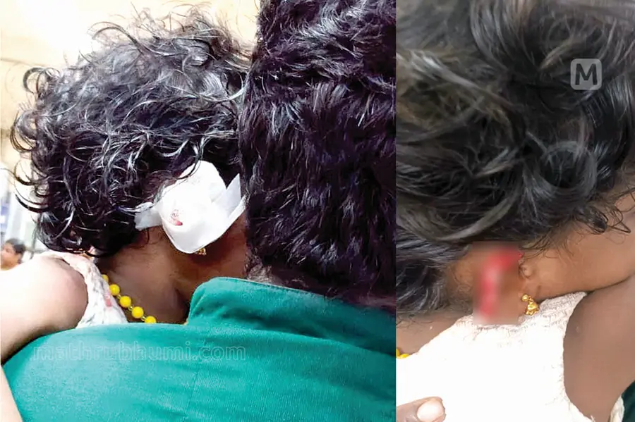 പറവൂരിൽ മൂന്നു വയസ്സുകാരിയുടെ ചെവികടിച്ചെടുത്ത നായയ്ക്ക് പേവിഷബാധ