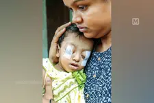 കണ്ണുനീരല്ല, കരഞ്ഞാല്‍ പൊഴിഞ്ഞുവീഴുക കണ്ണുകള്‍തന്നെ; അപൂര്‍വ രോഗവുമായി മല്ലിട്ട് ഒരു വയസുകാരി