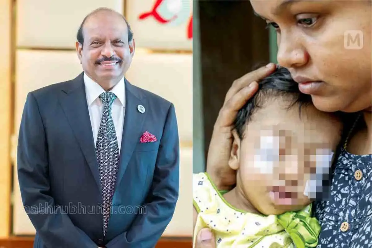 എം.എ യൂസഫ് അലി, കരഞ്ഞാല്‍ കണ്ണുകൾ പുറത്തേക്കുവരുന്ന അപൂര്‍വരോഗം ബാധിച്ച അദ്വൈത അമ്മ സജിനിയോടൊപ്പം | Photo: Mathrubhumi