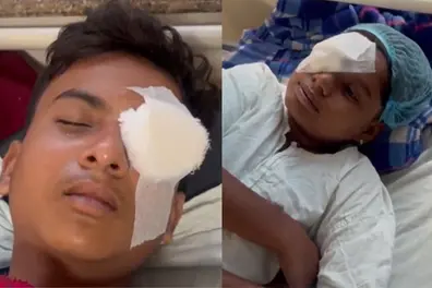 Over 60, including children, suffer burns, lose eyesight in Bhopal after using carbide guns for Diwali