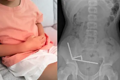 13-year-old boy swallows nearly 100 high-powered magnets, undergoes operation for tissue death