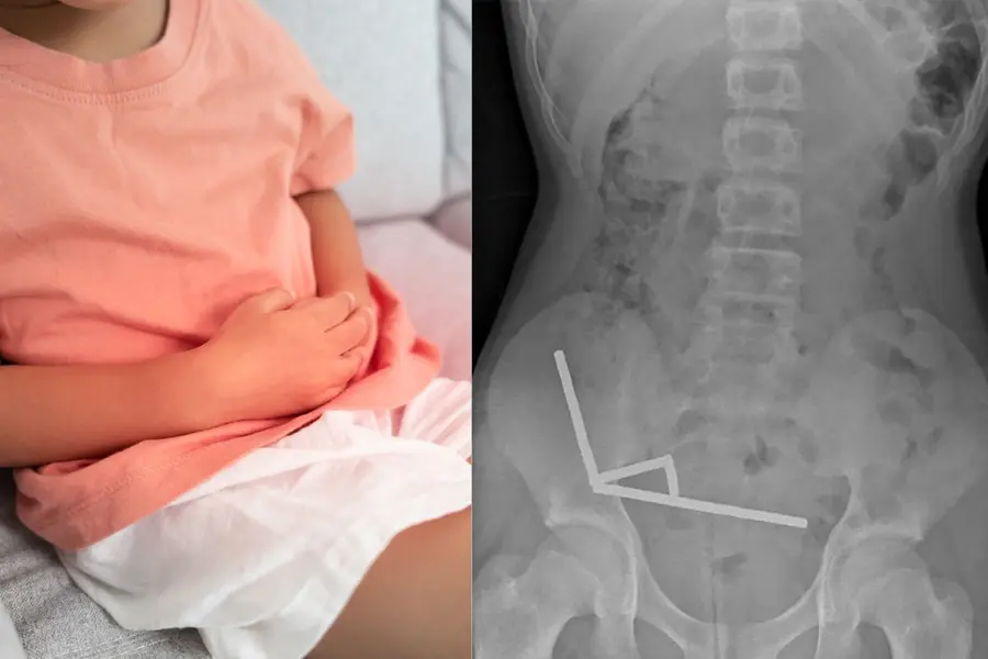 13-year-old boy swallows nearly 100 high-powered magnets, undergoes operation for tissue death