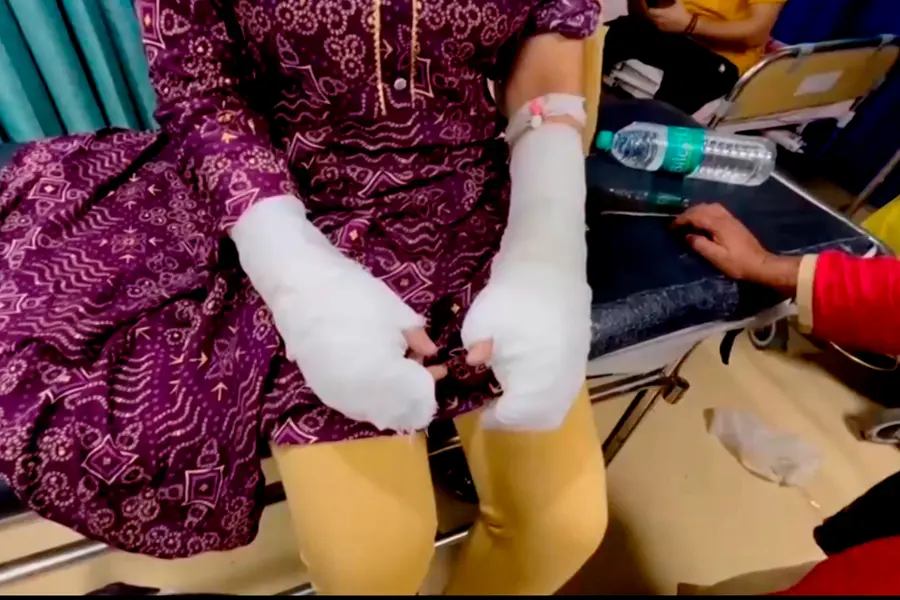 Woman undergoing treatment at the hospital following the acid attack | PTI