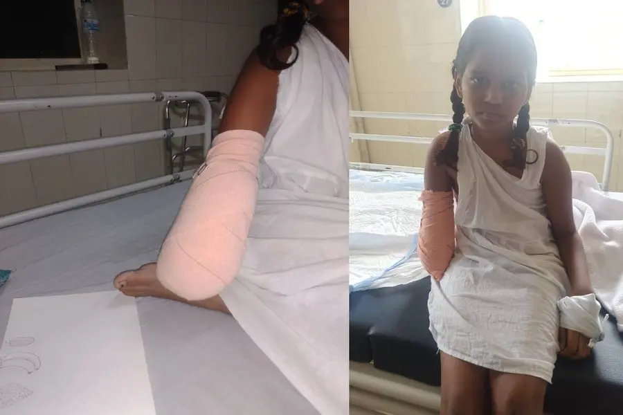 arm amputation