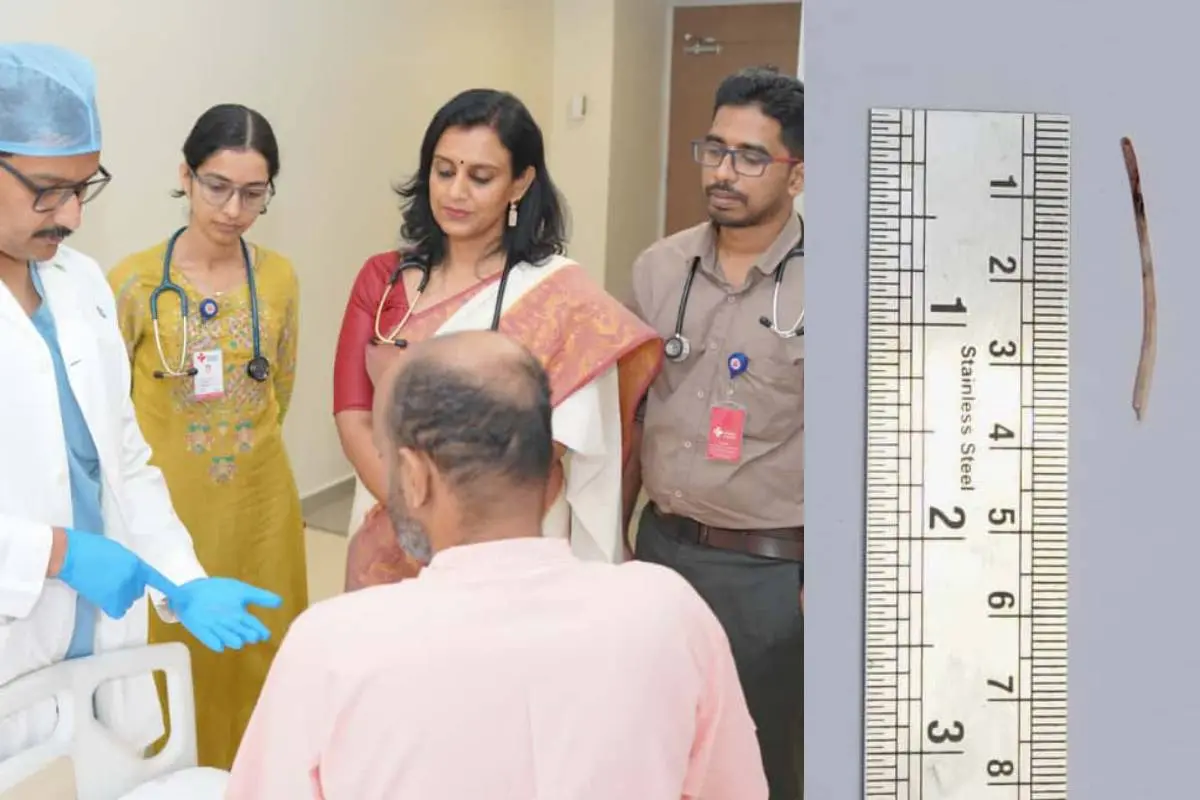 കരളിൽ നിന്ന് ശസ്ത്രക്രിയയിലൂടെ പുറത്തെടുത്ത മീൻമുള്ള് രോഗിയെ കാണിക്കുന്ന ഗ്യാസ്ട്രോ സർജൻ ഡോക്ടർ ജോസഫ് ജോർജ്. ജനറൽ മെഡിസിൻ വിഭാഗം സീനിയർ കൺസൾട്ടൻ്റ് ഡോ. ശാലിനി ബേബി ജോൺ സമീപം.