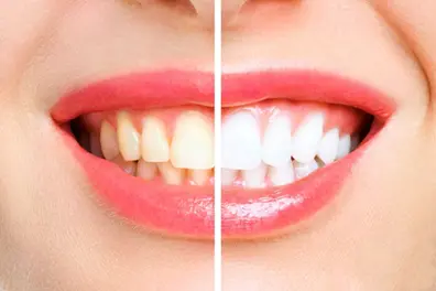 The truth behind whitening toothpaste: Does it brighten your smile or damage it?