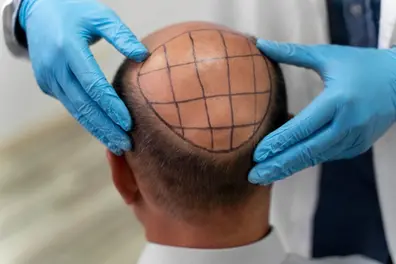 Just had a hair transplant? These everyday habits could damage it