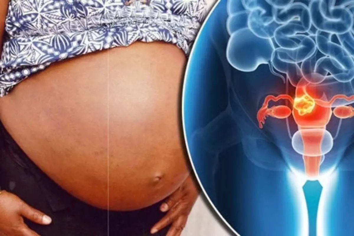 Fibroids are common, benign uterine growths that may affect pregnancy outcomes in some women, depending on their size and location, doctors say. Representative photo: Canva