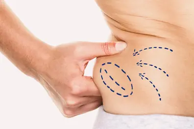 AI model shows high accuracy in predicting blood loss in liposuction procedures
