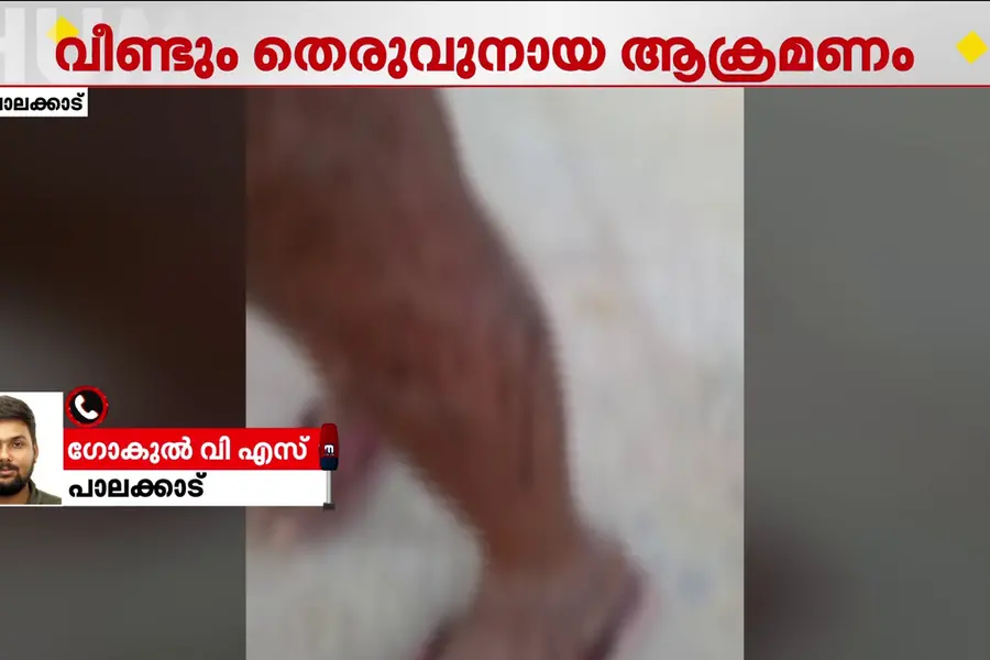 വീട്ടുമുറ്റത്ത് കളിച്ചുകൊണ്ടിരുന്ന കുട്ടിയെ തെരുവുനായ കടിച്ചു