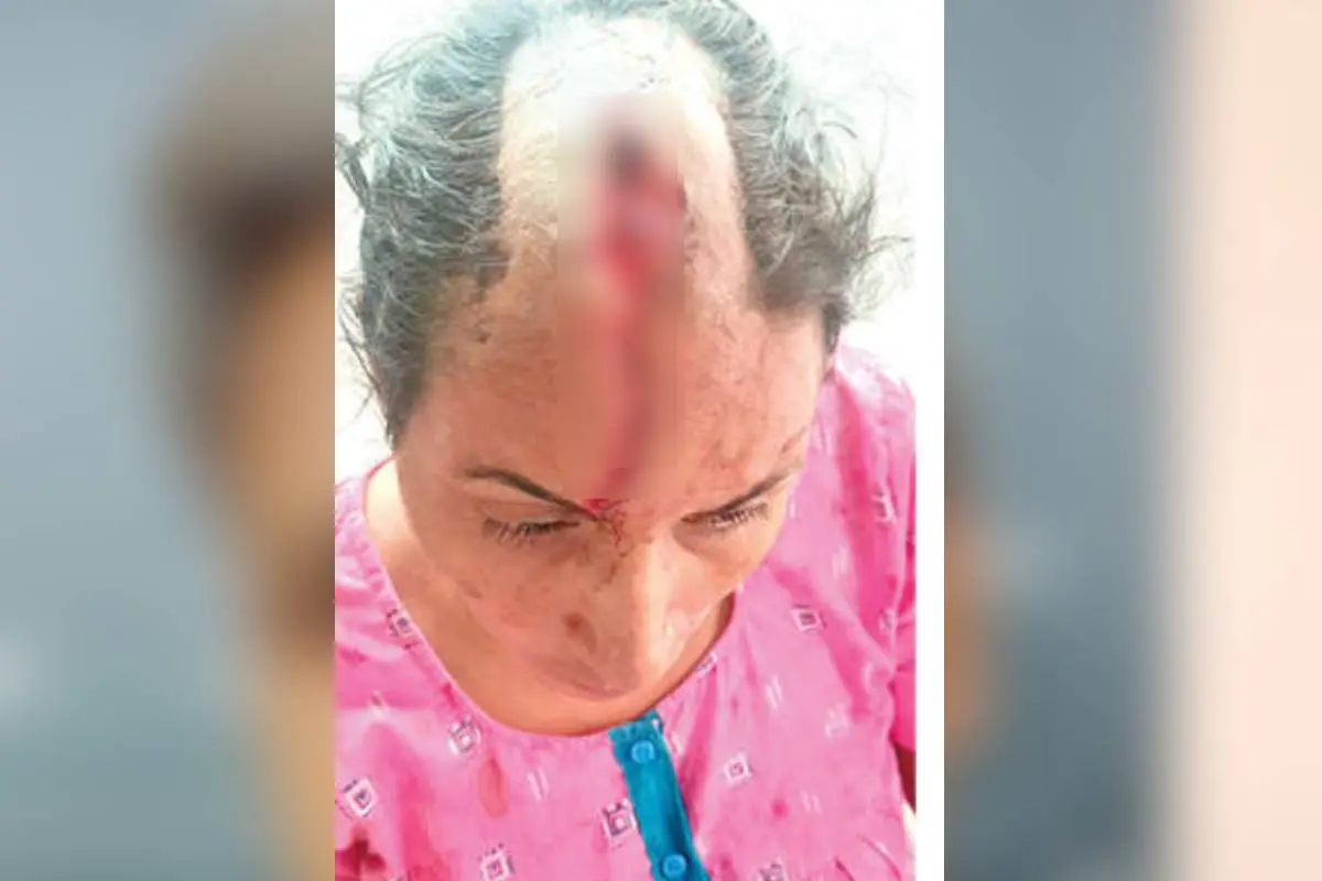 ഉദയംപേരൂർ അതിർത്തി റോഡ് തെക്കേ പുളിപ്പറമ്പിൽ സതിയുടെ തലയിൽ തെരുവുനായ കടിച്ചുണ്ടായ മുറിവ്.