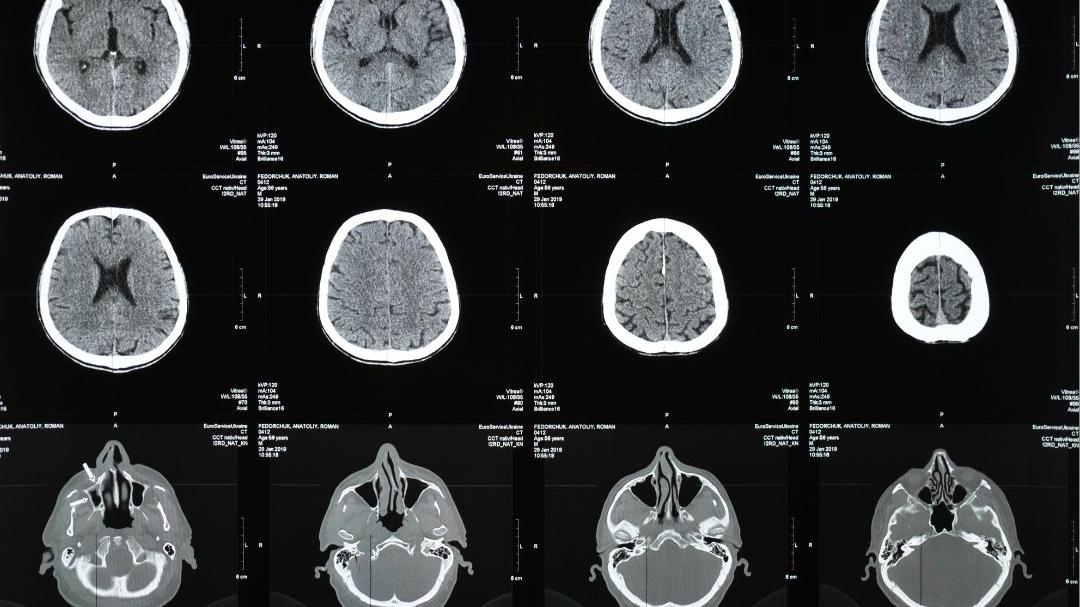 India poised to become second-highest Parkinson's burden: Experts warn of rising cases