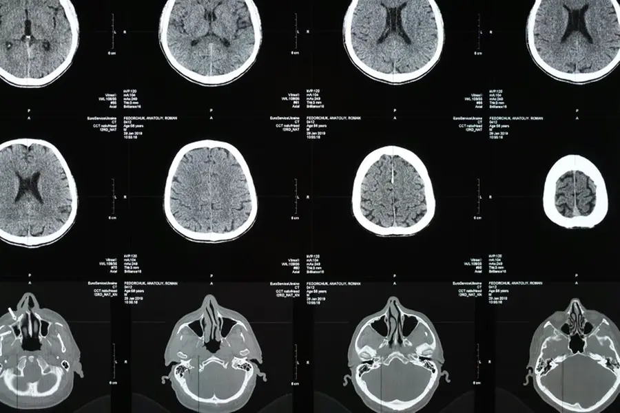 India poised to become second-highest Parkinson's burden: Experts warn of rising cases