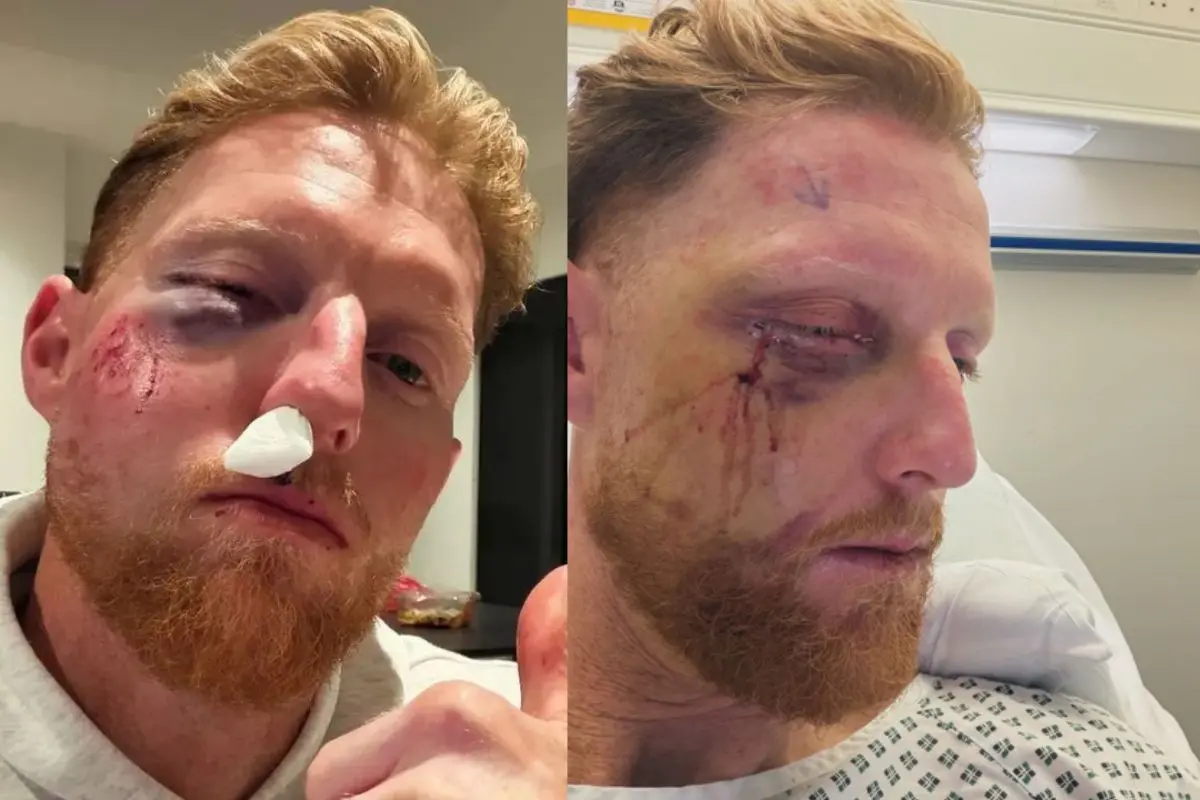 Ben Stokes undergoes successful eye surgery after being hit on the face with a ball. | Photos: Instagram