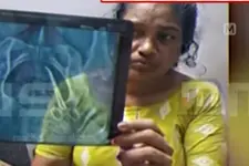 വയറ്റിൽ കത്രിക കുടുങ്ങിയ ഉഷയ്ക്ക് ഇന്ന് ശസ്ത്രക്രിയ; കുറ്റം കോവിഡിന്, ഡോ. ലളിതാംബികയ്‌ക്കെതിരെ കേസ്