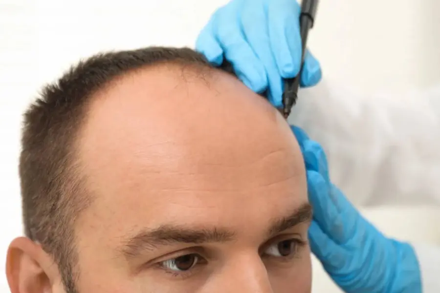 Hair Transplantation