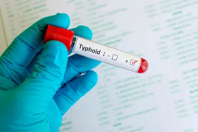 Children under 10 bear biggest burden of typhoid in India: Study