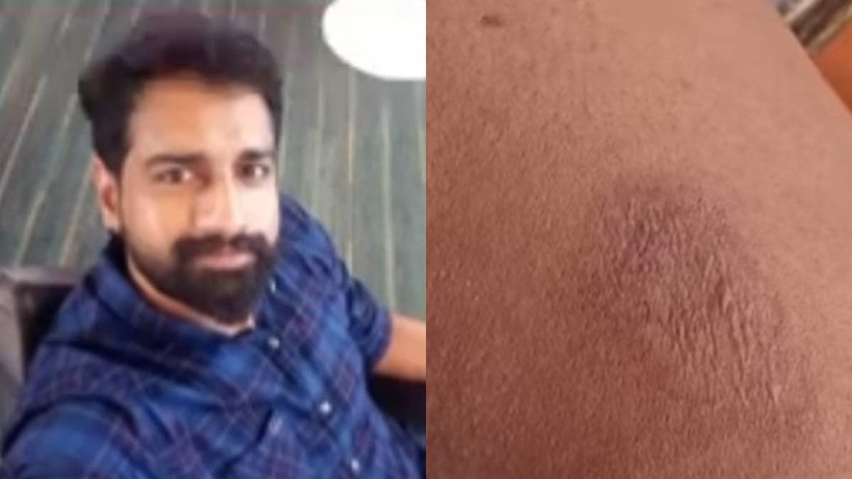 A 37-year-old man dies of sunstroke in Kannur as Kerala faces rising temperatures. Heatwave alerts issued; others affected in Kozhikode and Malappuram