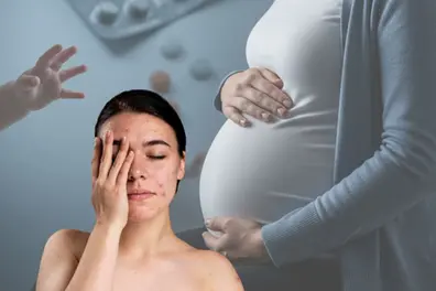 Can acne drugs endanger pregnancy and baby? Kerala study warns risks; experts urge caution