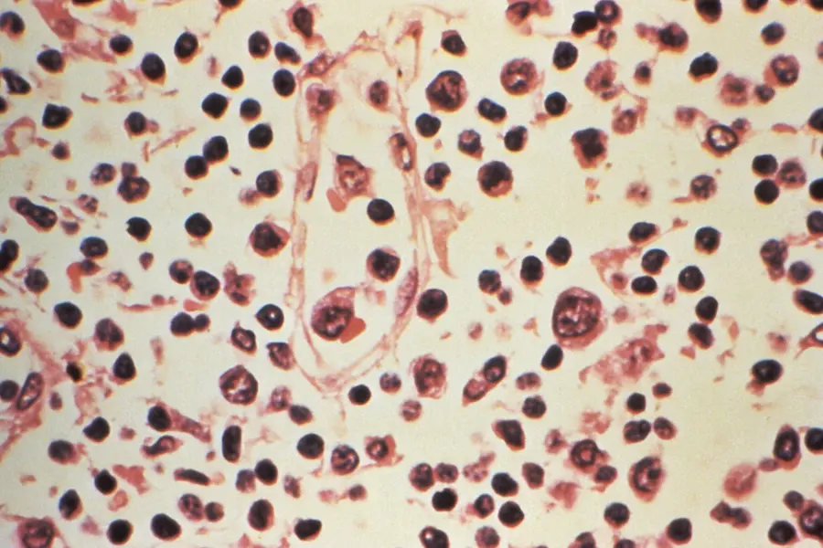 Hantavirus