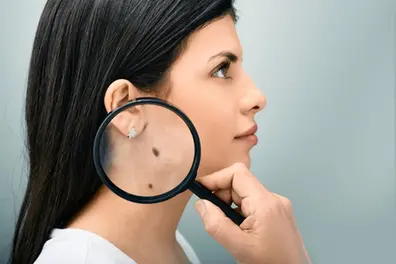 What if your skin had a checklist; understanding the ABCDE rule