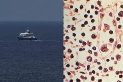 Canada confirms hantavirus case linked to MV Hondius cruise ship outbreak