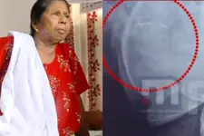 കുത്തിവെച്ചപ്പോൾ ദേഹത്ത് കുടുങ്ങിയ സൂചിയുമായി വത്സല കഴിഞ്ഞത് ഒരുവർഷം; തീരാവേദനയിൽ ജീവിതം