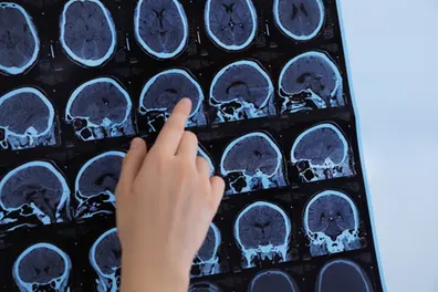 Often mistaken for stress, this hidden neurological disorder is affecting more young Indians