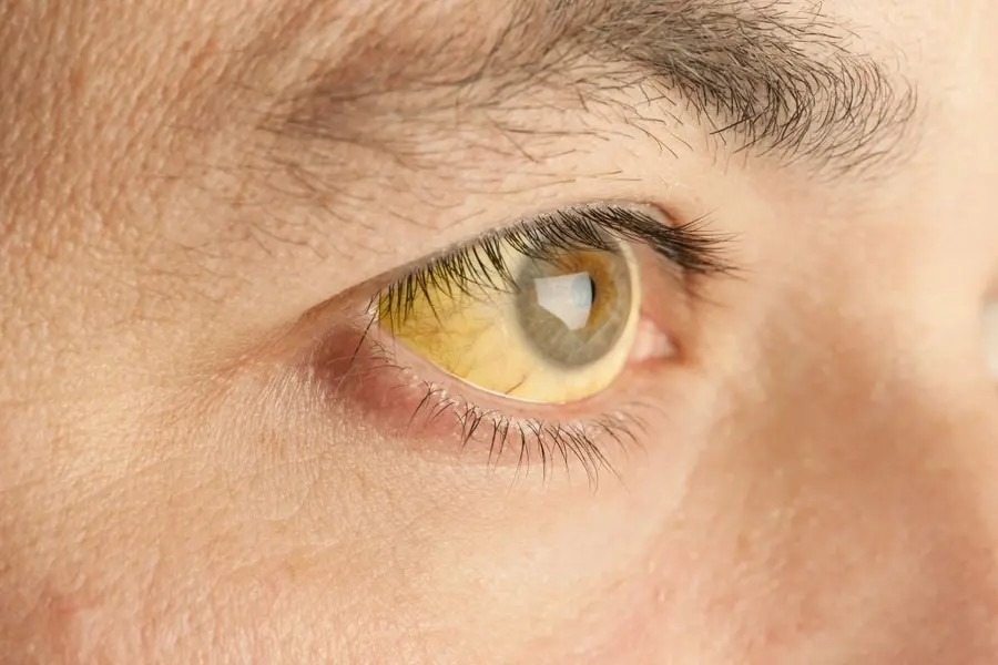 jaundice