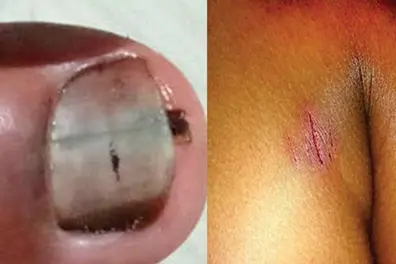 12-yr-old Kerala boy faces savage torture with chilli in eyes, toothpicks under nails; kin booked