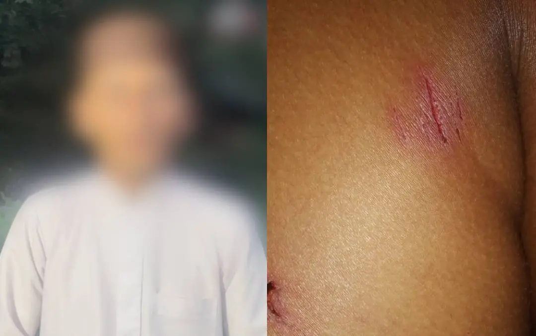 മര്‍ദനമേറ്റ കുട്ടിയുടെ സഹോദരന്‍, കുട്ടിക്ക് മര്‍ദനമേറ്റ പാടുകൾ