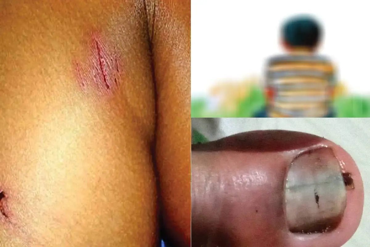 പിതാവിന്റെ ബന്ധുക്കളുടെ ക്രൂരമർദനമേറ്റ പന്ത്രണ്ടുകാരന്റെദേഹത്തേറ്റ മുറിവുകൾ
