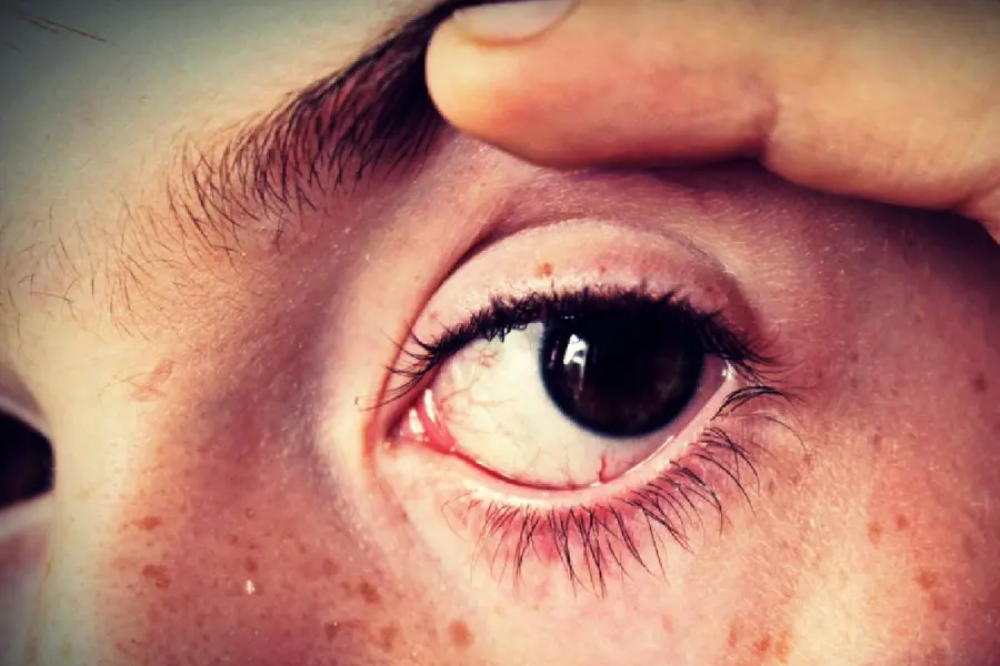 eye