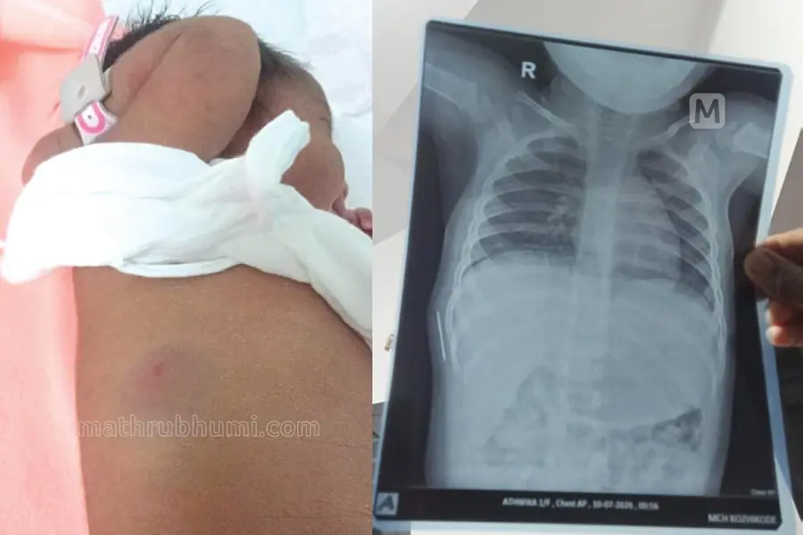 Medical Negligence: Needle Found in Baby's Body After a Year
