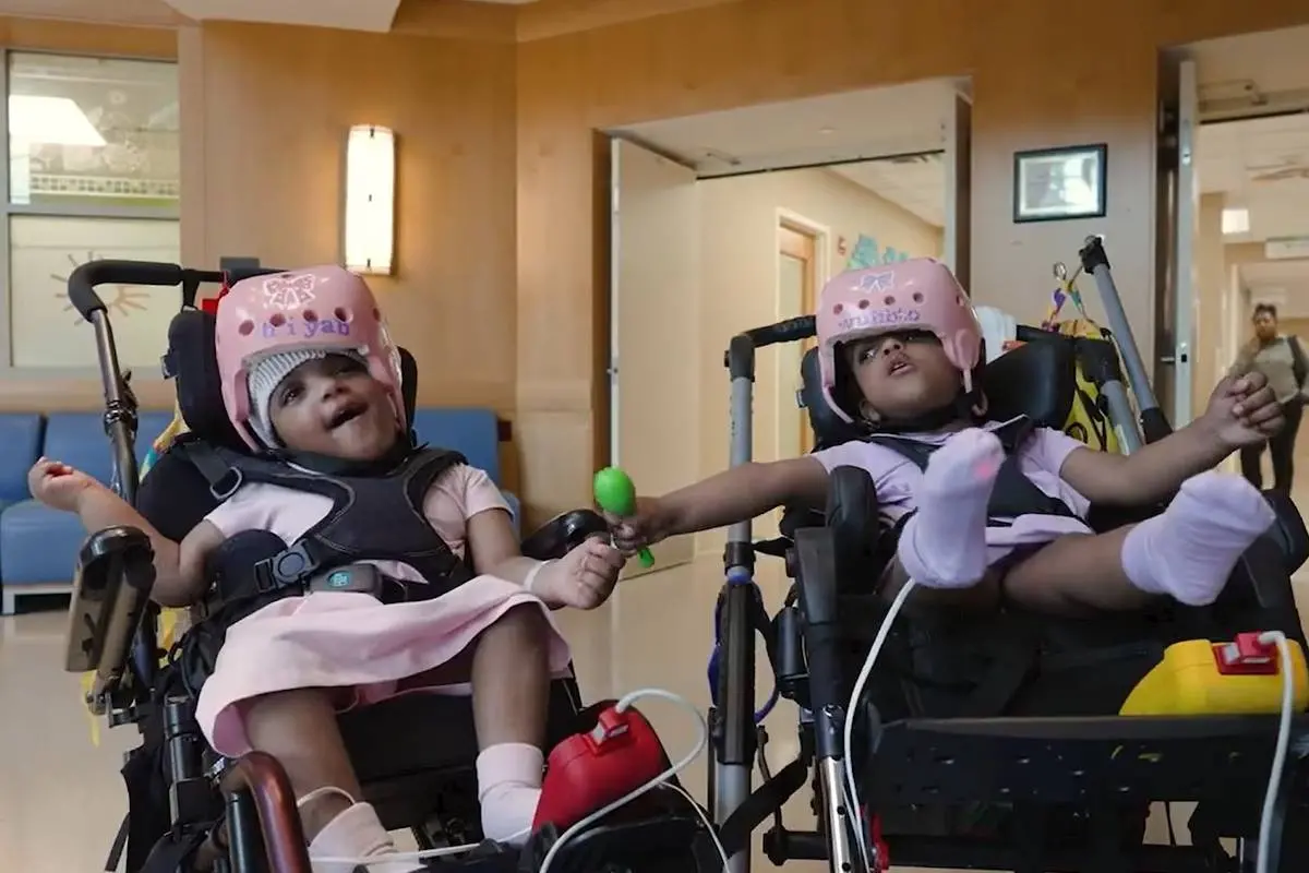 ശസ്ത്രക്രിയയിലൂടെ ഇരുവരെയും വേർപെടുത്തിയപ്പോൾ| Photo: SSM Health Cardinal Glennon Children's Hospital