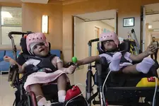 25 മണിക്കൂർ നീണ്ട ശസ്ത്രക്രിയ, രണ്ടുവയസ്സുള്ള സയാമീസ് ഇരട്ടകളെ വിജയകരമായി വേർപെടുത്തി
