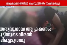 നഗരൂരിൽ തെരുവുനായ ആക്രമണം; 11 വയസ്സുകാരന്റെ വിരൽ കടിച്ചെടുത്തു; കുട്ടി ചികിത്സയിൽ