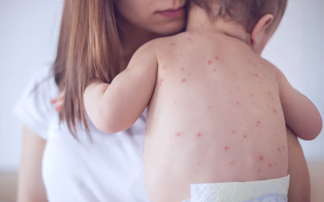 Measles - Representative image | Photo: Canva