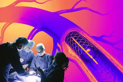 Is angioplasty about the heart or business? Kerala CM’s stent remarks spark debate; experts urge caution