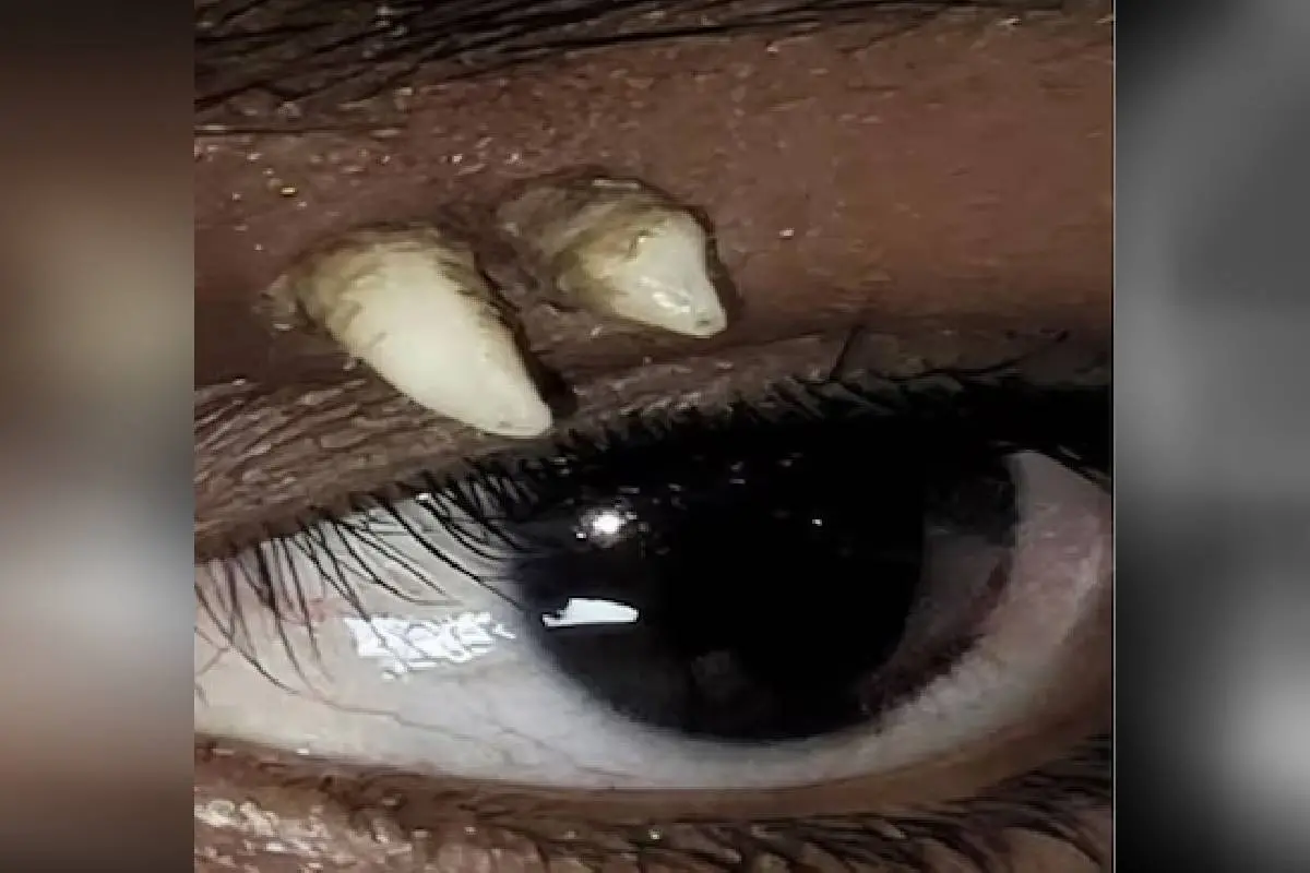 കൺതടത്തിൽ പല്ല് വളർന്ന അവസ്ഥ| Photo: American Academy of Ophthalmology.