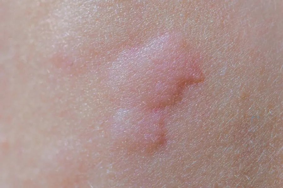 hives